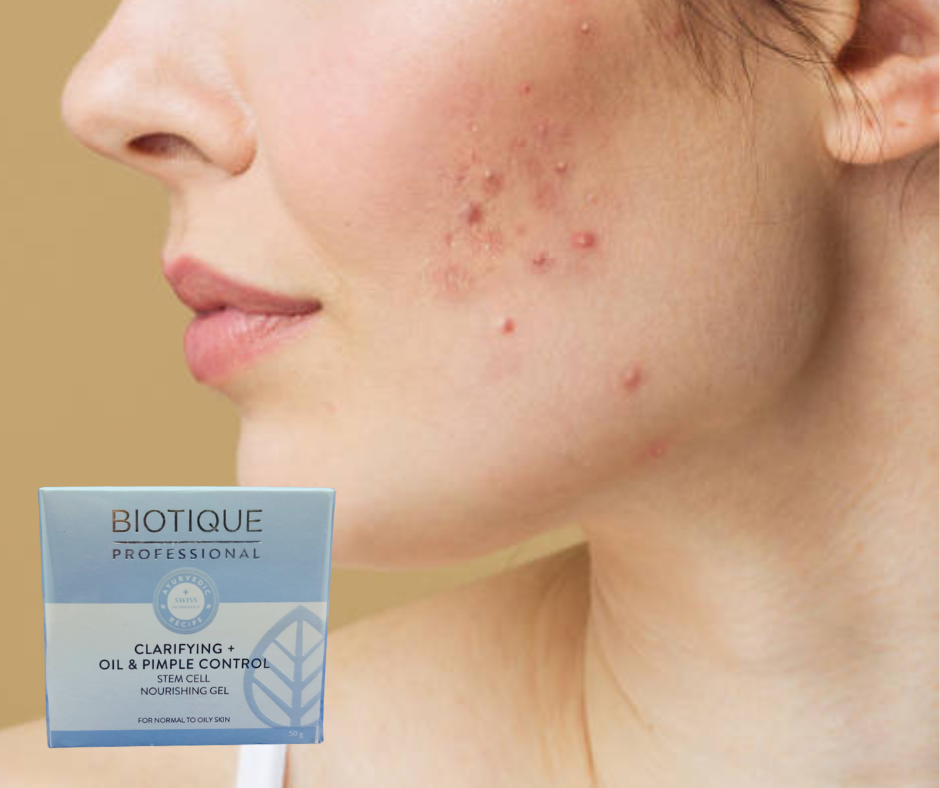 Biotique Professional Clarifying Oil & Pimple control Nourishing Gel