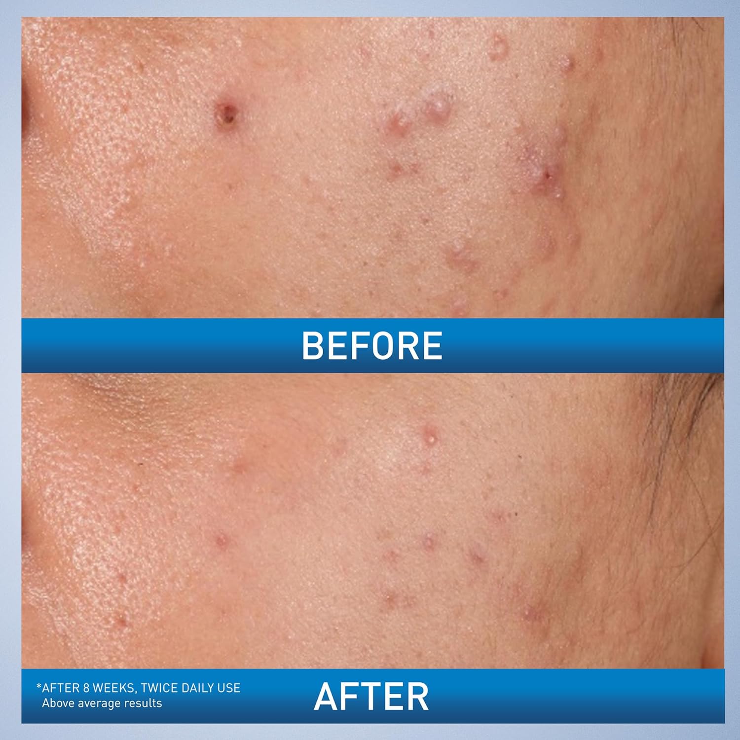 CeraVe Acne Control Gel 40ml