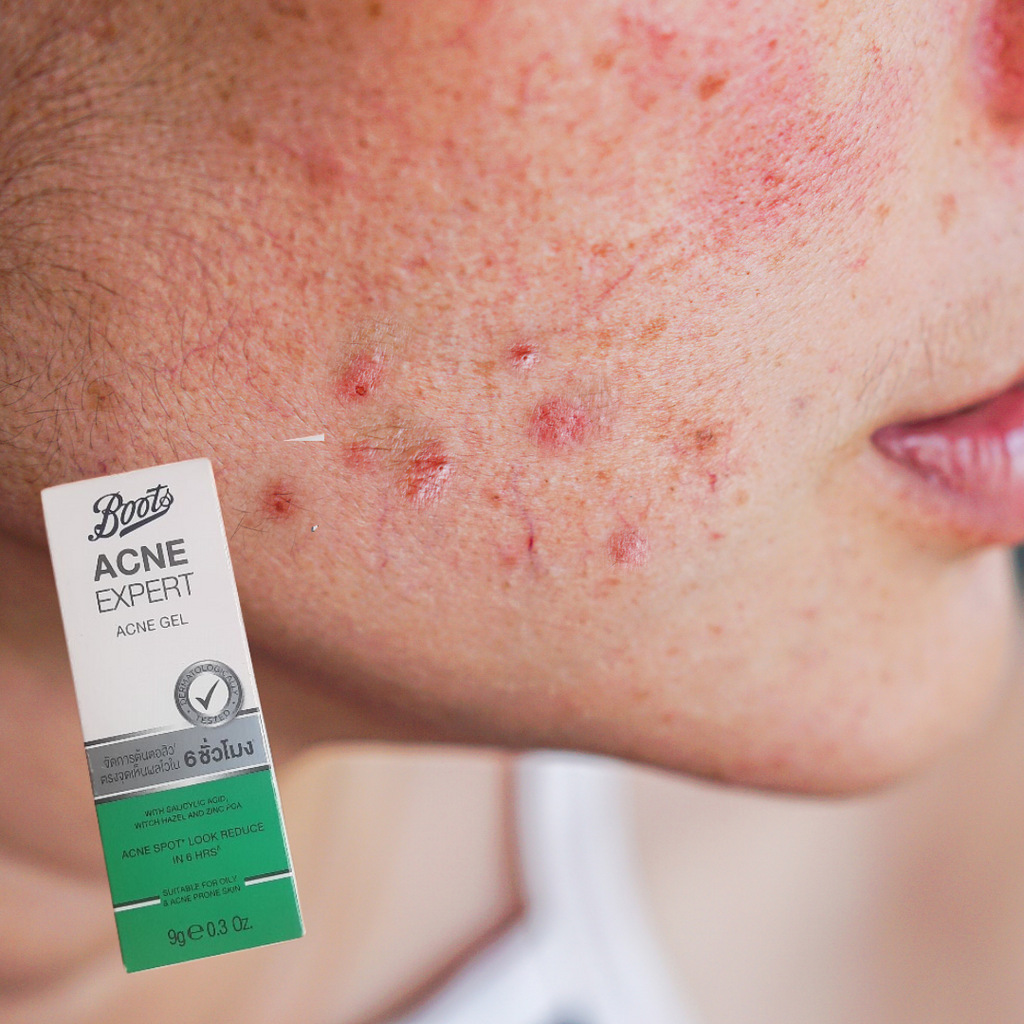 Boots Acne Expert Acne Gel 9g