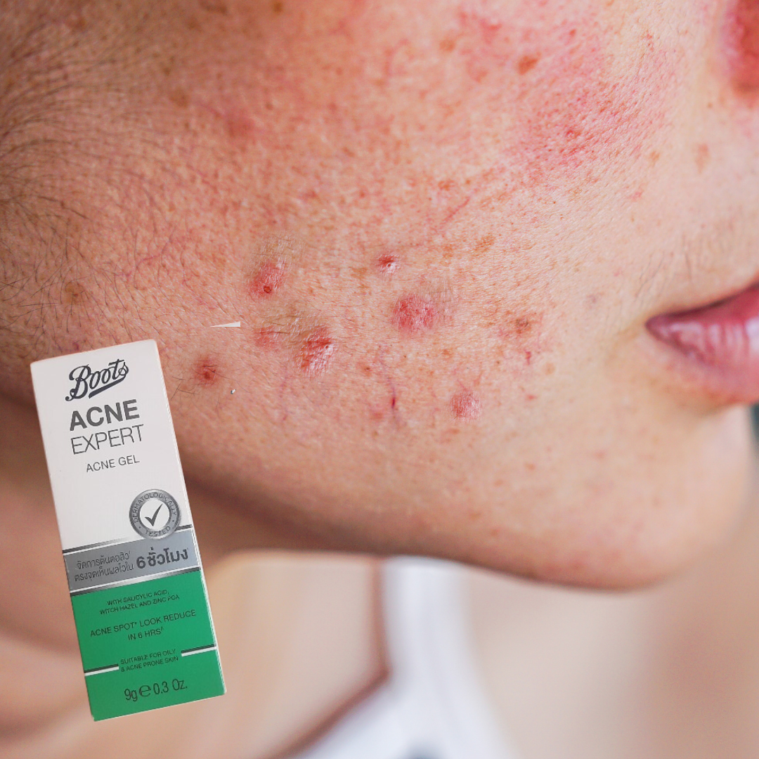 Boots Acne Expert Acne Gel 9g