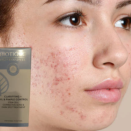 Biotique Professional Clarifying Pimple Control Dark Spot Treatment