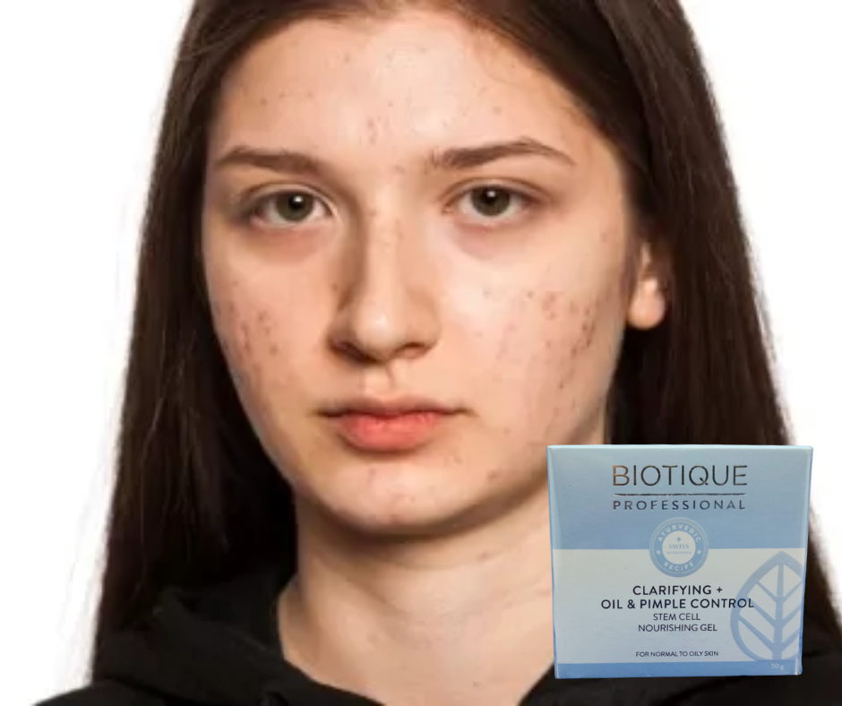 Biotique Professional Clarifying Oil & Pimple control Nourishing Gel