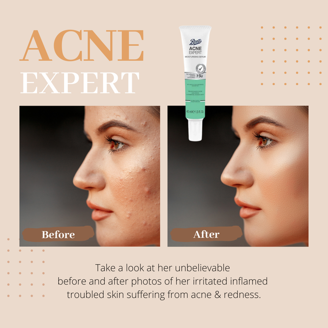 Boots Acne Expert Moisturising Serum 40ml
