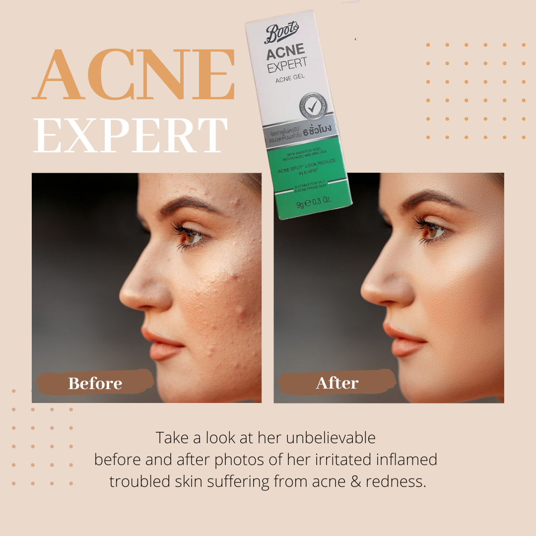 Boots Acne Expert Acne Gel 9g